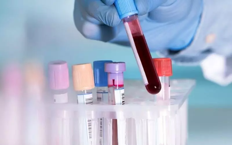 Xét nghiệm công thức máu được thực hiện để tìm nguyên nhân viêm đại tràng
